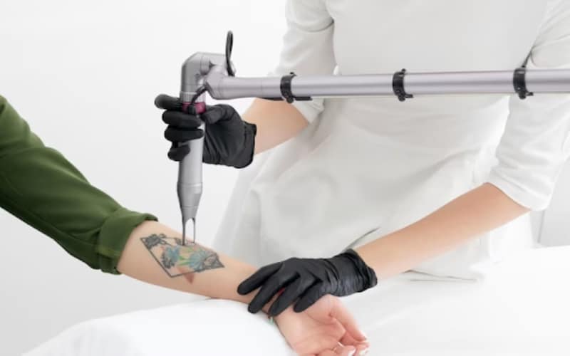 Unlocking Freedom The Journey of Laser Tattoo Removal1