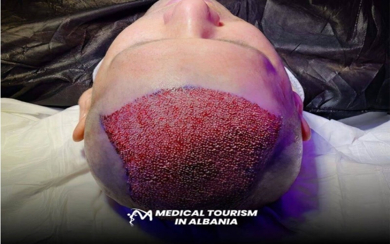 Top Countries for Hair Transplants Albania Takes the Lead1